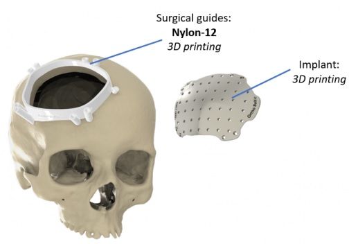 Cranial implants