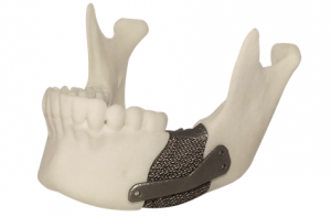 Anatomical model_mandible trabecular implant