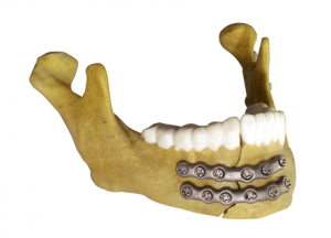 Anatomical model - mandible fracture fixation