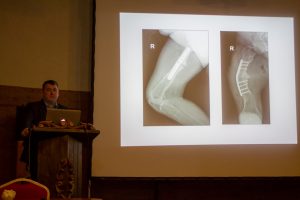 Case Story presentation by V. Toliušis. Fixing femoral deformity by using patient-specific surgical guides
