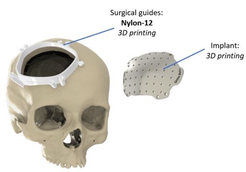 https://balticimplants.eu/wp-content/uploads/2016/12/cranial-implants.jpg?utm_source=chatgpt.com
